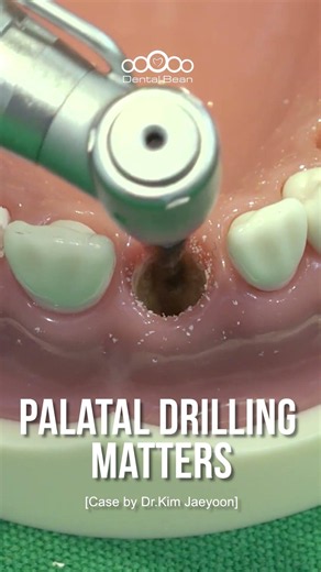 Palatal Drilling Matters #Dentalbean