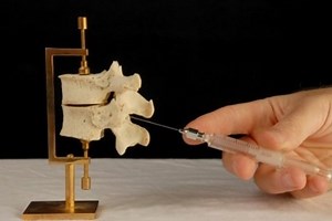 What's the Difference Between Epidural and Spinal Anesthesia?