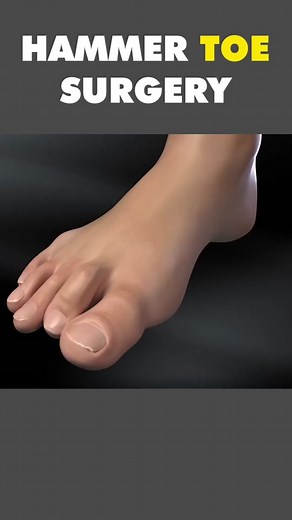 Hammer Toe Surgery 3D Animation #hammertoesurgery #hammertoesugery #hammertoes #hammertoefusion #hammertoerepair #footsurgery #toesurgery #medical3danimation #3dmedicalanimation