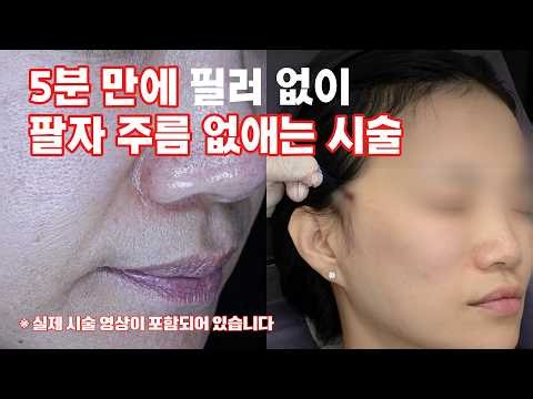 5분 만에 필러 없이 팔자 주름 없애는 시술 (Korean thread lift for nasolabial folds — 5 minutes, no filler 🇰🇷)