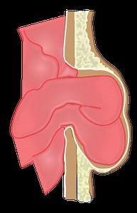 Incarcerated umbilical hernia - Critical Care Sonography