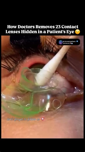 NextGenAI 🚀🤖 on Instagram: "Doctors were stunned after discovering 23 contact lenses trapped inside a single eye — a rare but serious medical case that shocked even experienced specialists. Over time, each lens had slipped behind the eyelid and remained hidden in the conjunctival sac, a small space between the eyelid and the eyeball. With every blink, the lenses were pushed deeper instead of coming out. Because the eye can stretch slightly, the patient didn’t feel immediate pain, allowing the 