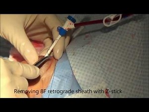 Thrombectomy of dialysis AVG