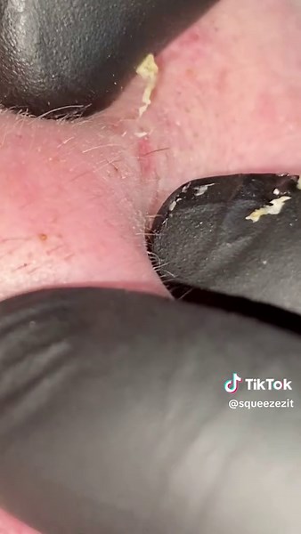 Stunning Pimple Popping Event Caught on Camera