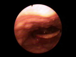Fiberoptic Endoscopic Evaluation of Swallowing (FEES)