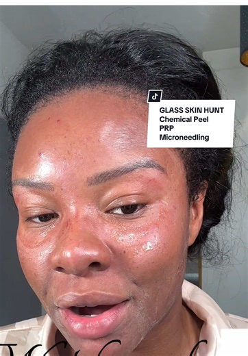 Revitalize Your Skin: Chemical Peel and PRP Treatment