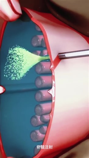 How Spinal Injection Is Given? (3D Animation） #spinalinjection#spinalinjections#spinepain#spinepainrelief #spinepainrelieve #medical3danimation #3dmedicalanimation #fyp