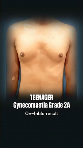 Teen Manboobs Gone! Grade 2A Gynecomastia Transformation #shortsfeed
