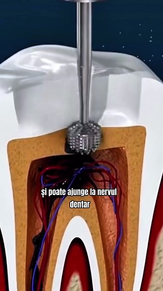 Ce se întâmplă când nu tratezi o carie la timp?#CviaDent #ZâmbeteCuGrijă #creatorsearchinsights #stomatologie #ClinicăStomatologică