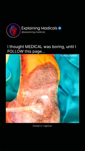 Medical | Health | Anatomy on Instagram: "This is how NPWT (Negative Pressure Wound Therapy) looks and works. Negative Pressure Wound Therapy is an advanced medical technique used to help wounds heal faster and more effectively. A special foam or gauze dressing is placed directly over the wound and sealed with an airtight transparent film. This dressing is then connected to a small vacuum pump that applies controlled negative pressure (suction). Biologically, this suction removes excess fluid, p