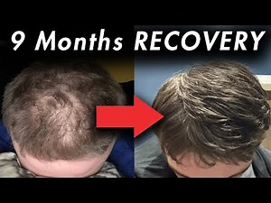 9 Month Hair Loss Recovery: Diffuse Recovery