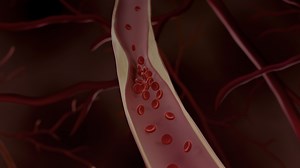 Addressing the Unique Cases of Portal Vein Thrombosis