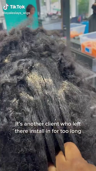 Effective Ways to Remove Dandruff from Braids and Scalp