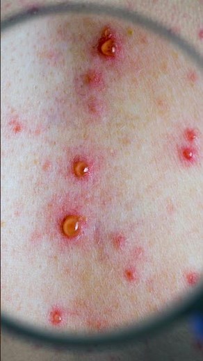 Varicelle Symptoms EXPLAINED