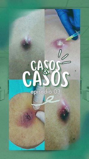 Como os abscessos se formam e cuidados necessários