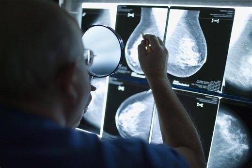 Des médecins appellent à abaisser de 50 à 45 ans l’âge du dépistage du cancer du sein | RTS