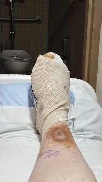 The toe is gone. #diabetes #diabetesawareness #toeinfection