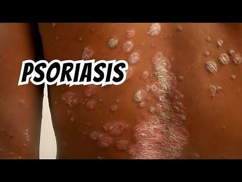 Understanding Psoriasis: Types, Causes, and Treatment Options