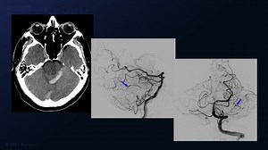 #61: Superior Petrosal Sinus Dural Arteriovenous Fistula Masquerading as a Petrosal Cerebellar Arteriovenous Malformation - Dural Arteriovenous Fistula - Seven Series Collection