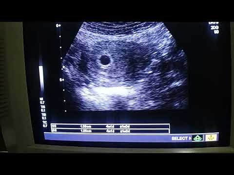 How to find gestational sac with TAS ultrasound at 4 weeks by Dr Fatima