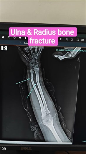 Ulna Radius bone fracture #anatomy #viral #pathology