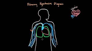 Pulmonary hypertension diagnosis Swan Ganz catheterization