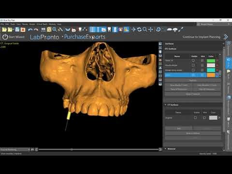 Making a Guide for Implant Placement and a Lateral Window Sinus Lift