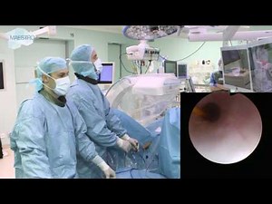 Inspection of the ureter for residual fragments