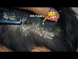 Extreme Dandruff Scratching And Removal #1058
