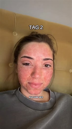 Vanessa Berg | CO2 LASER BEHANDLUNG • anzeige Ich hatte letzte Woche eine CO2 Laserbehandlung bei @dr.emi und wollte euch nochmal ein zusammenfassendes... | Instagram