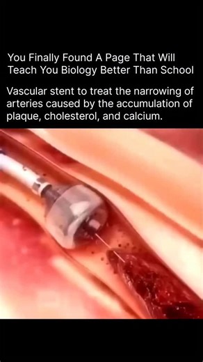 BIOLOGY | MEDICAL | HEALTH | A vascular stent is a tiny, mesh-like metal tube used to open narrowed or blocked arteries. Over time, plaque—made of cholesterol, fat,... | Instagram