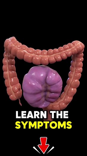 Learn more about Colon cancer early signs, what to watch for and how treatments can help. | Ciencia Espacial