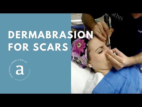 Dermabrasion for Scars | Live Demo by Dr. Athre