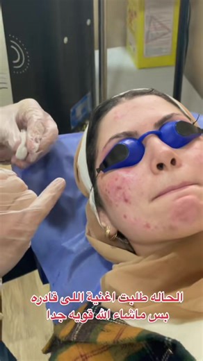 تقشير كيميائي: التجربة والنتائج مع د. وائل منصور