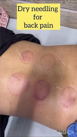 3K views · 19 reactions | During a dry needling treatment, one or...