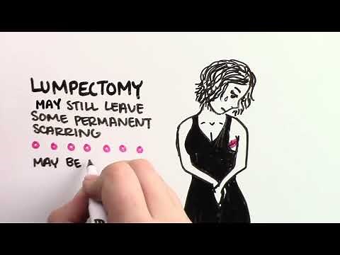 Hidden Scar Lumpectomy Explained Video