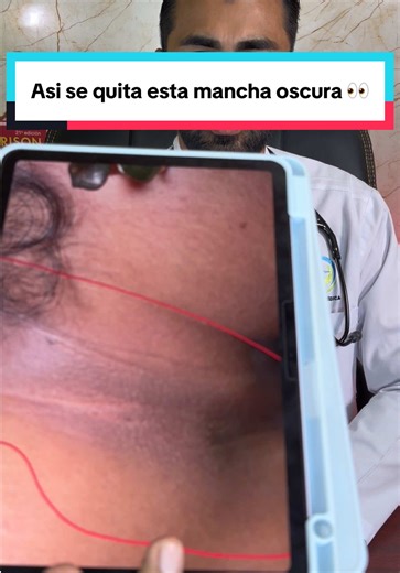 ¿Cómo quitar ese “cuello sucio”? Muchas veces la clave no está en tallar la piel… sino en corregir el metabolismo. #ResistenciaALaInsulina #AcantosisNigricans #Prediabetes #Diabetes #SíndromeMetabólico