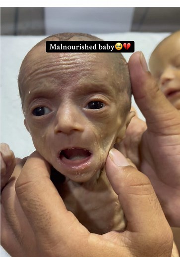 Understanding Malnourishment in Premature Babies