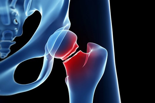 Fracture du col du fémur : signes, opération, rééducation