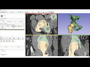 Creating femur model from CT volume using 3D Slicer