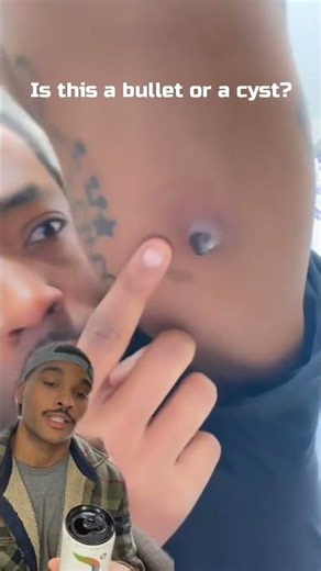 Is this a bullet or a cyst?