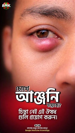 চোখের অঞ্জনি ছাড়াতে কি কি ওষুধ প্রয়োগ করতে হবে? #banglamedicine #মেডিকেল #মেডিকেল_ভর্তি #medicine
