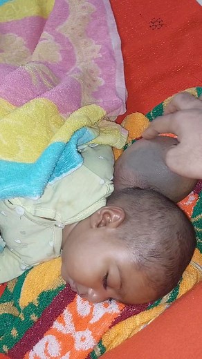 Encephalocele | Dr. Khaled Hasan Milu