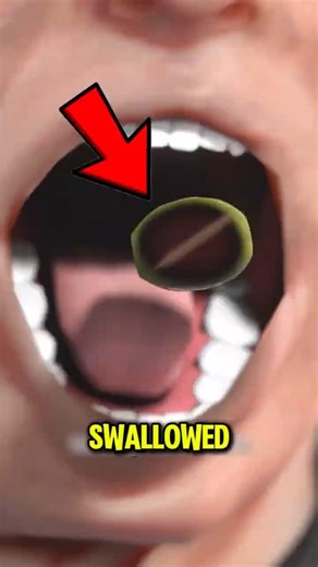 Horrifying Things Humans Accidentally Swallowed ‼️😱#shorts #viral