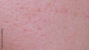 Extremely close-up technology of problem skin of a person with large own pores, acne scars.