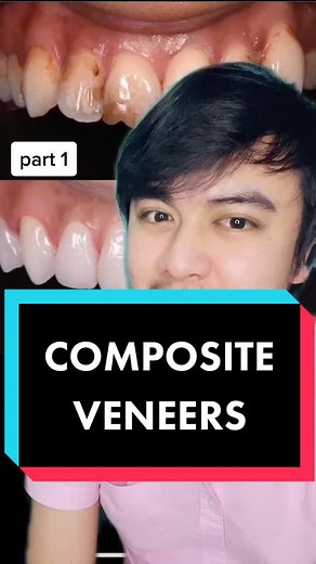 Understanding the Differences: Composite Veneers vs Direct Veneers