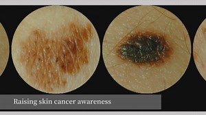 Skin cancer awareness: Why skin self-exams are important