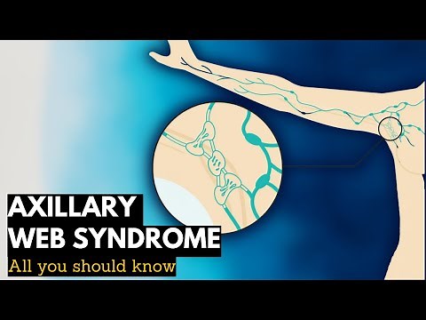 Axillary Web Syndrome: Everything You Need To Know