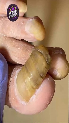 Simple Steps to Support Dry Cuticles For Long-Term Comfort 🌷💐 #noninvasive #diabeticsupport #footcare | NC State Wolfpack on TheWolfpacker.com