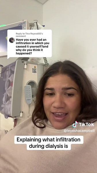 Understanding Infiltration During Dialysis Procedures